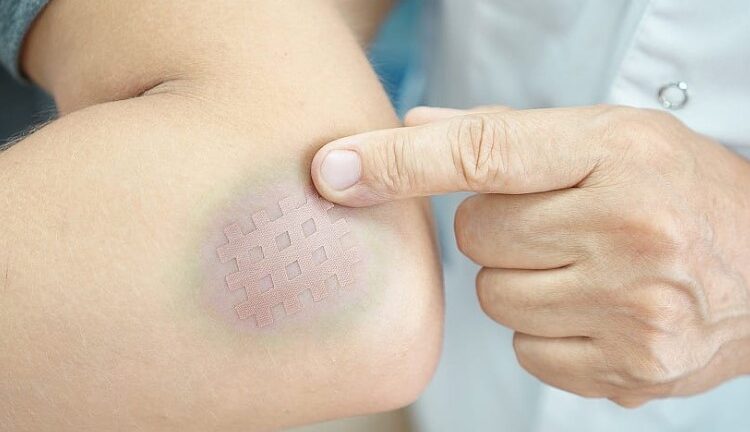 Що таке гематома